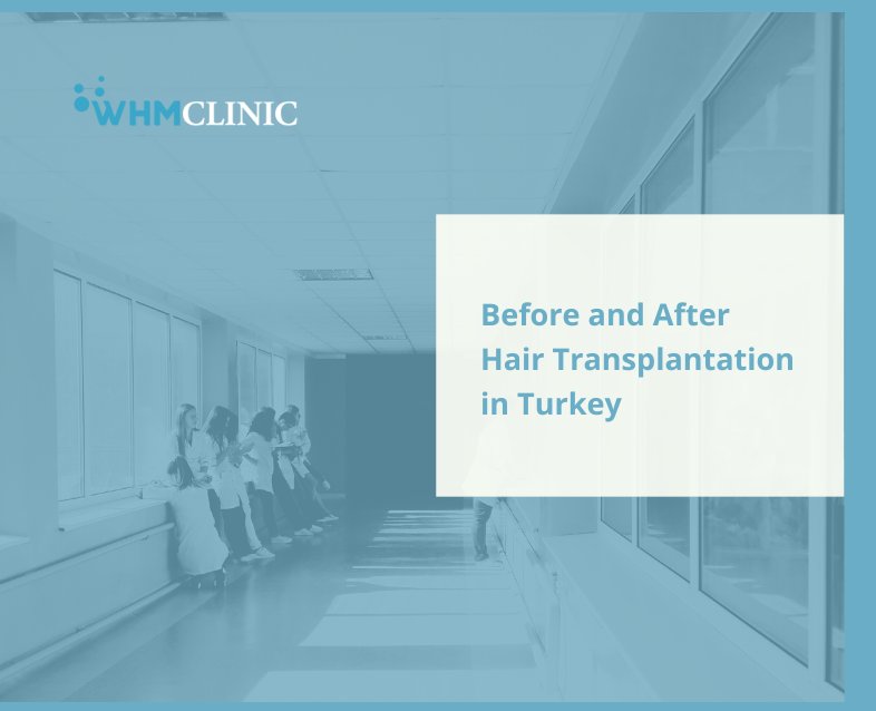 Before and After Hair Transplantation in Turkey